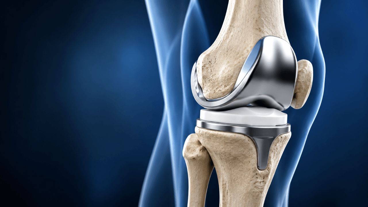Cost of Knee Replacement Surgery in India