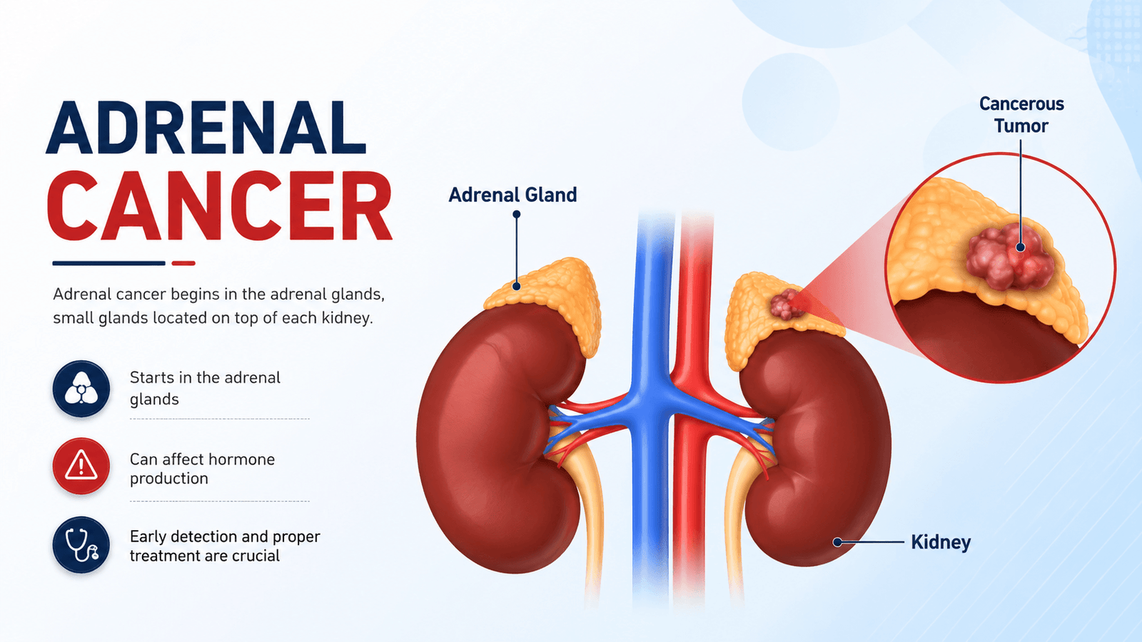 Adrenal cancer illustration