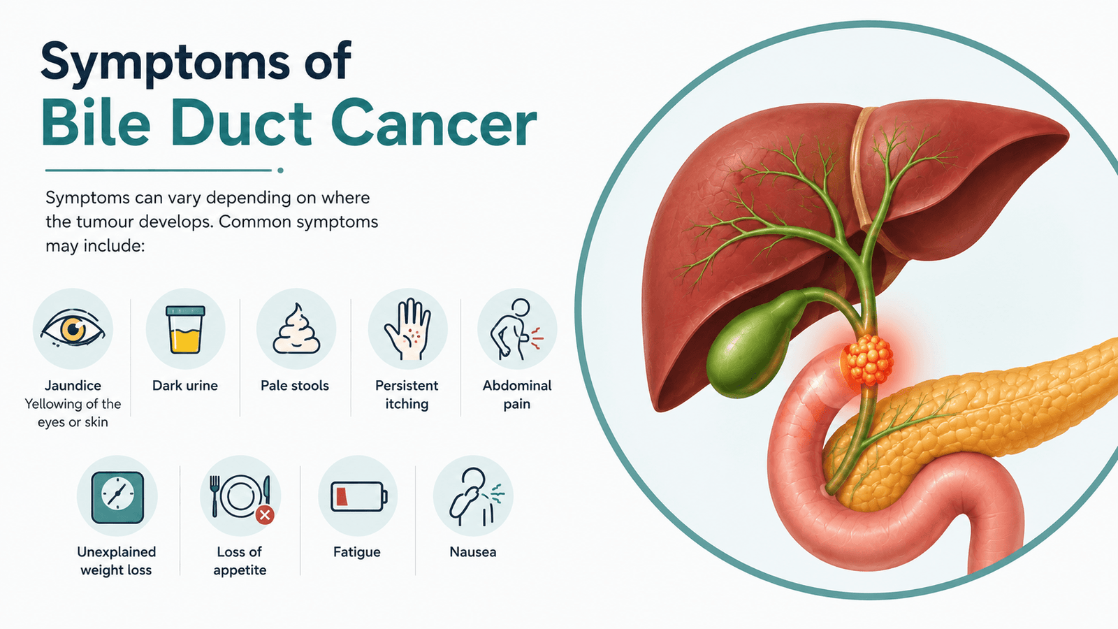 Symptoms of bile duct cancer illustration