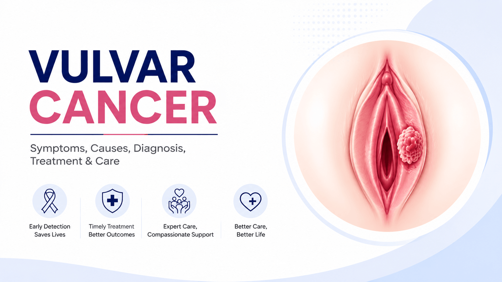 Vulvar cancer illustration