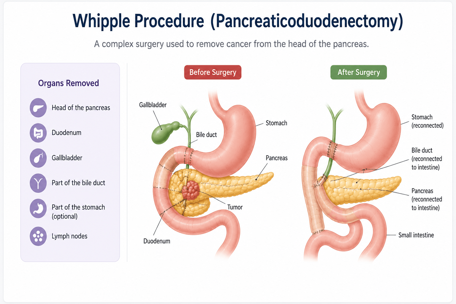 Whipple surgery procedure in operating room