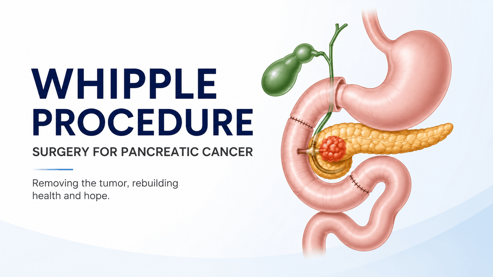 Whipple procedure for pancreatic cancer illustration