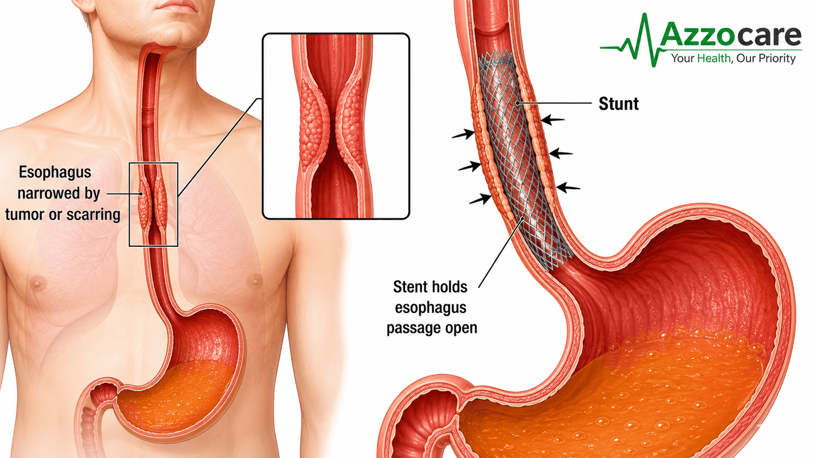Esophageal cancer stent cost in India