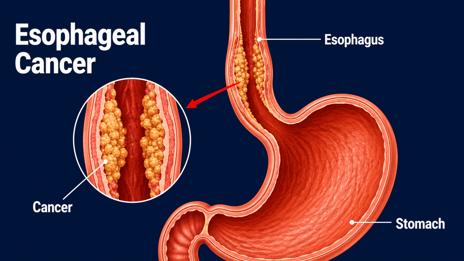 Esophagus cancer treatment in India