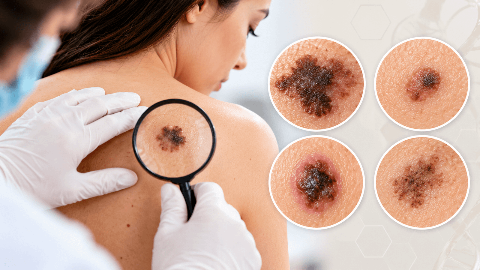 Signs and Symptoms of Melanoma Skin Cancer