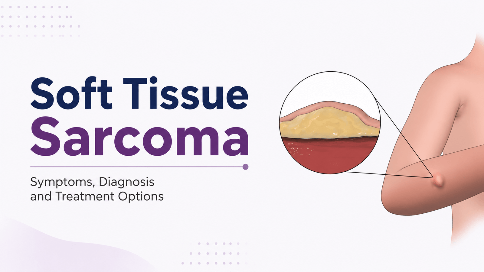 Soft tissue sarcoma treatment in India